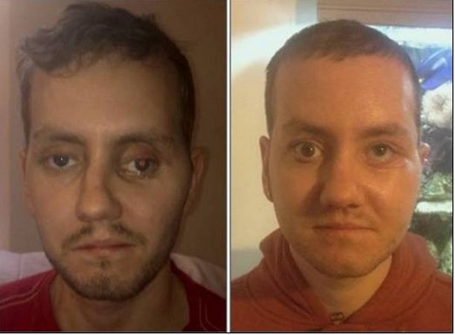 Британцу восстановили лицо с помощью 3D-принтера